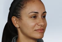 Michelle before treatment