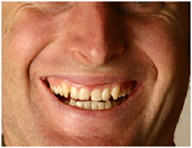 Bye-Bye, Buck Teeth! How to Overcome an Overbite