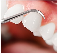Receding Gums: Are Your Teeth in Peril?