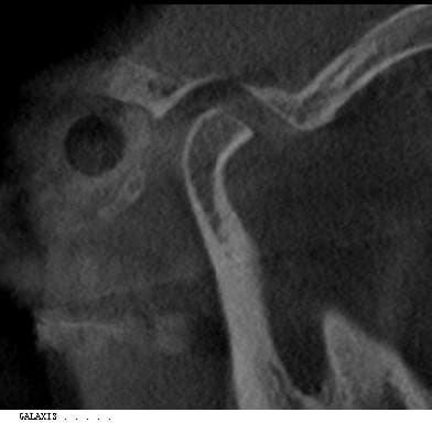 Signs of TMD