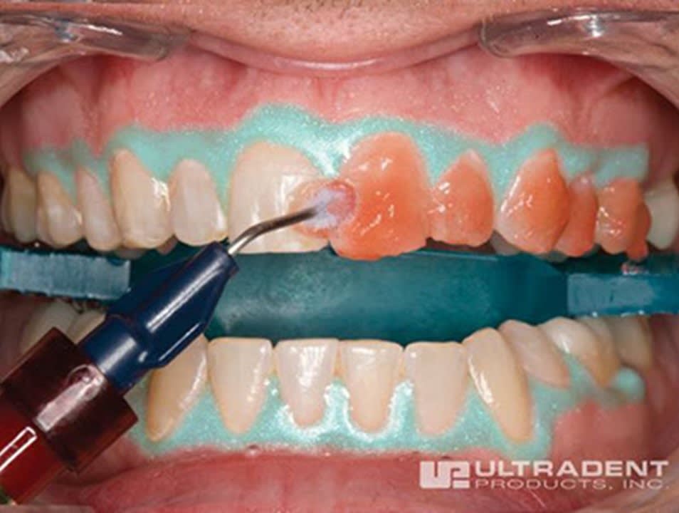 Differences Between at Home And In Office Tooth Whitening Procedures