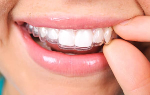 Braces Vs Invisalign Which Is Better Definition Dental