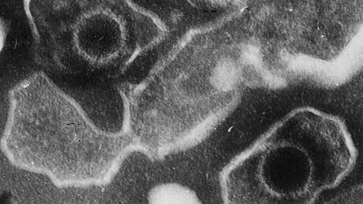 Epstein-Barr Virus: Symptoms, Transmission and Health Risks Explained