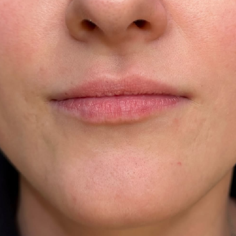 Aumento de labios — Antes