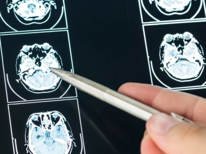 Роспотребнадзор рассказал о ситуации с заболеваемостью менингитом в России