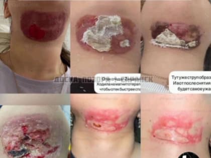 Женщина получила обморожение шеи третьей степени после услуги в салоне красоты Саранска