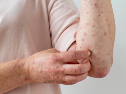 В Мордовии 14 июля обнаружена опасная вспышка кори