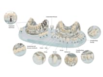 Study Model Demo Implant C+B img
