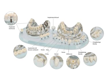 Diversen Study Model Demo Implant C+B img