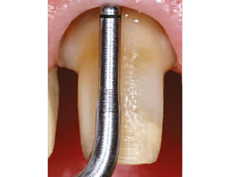 Satelec insert PM3 A29754 img