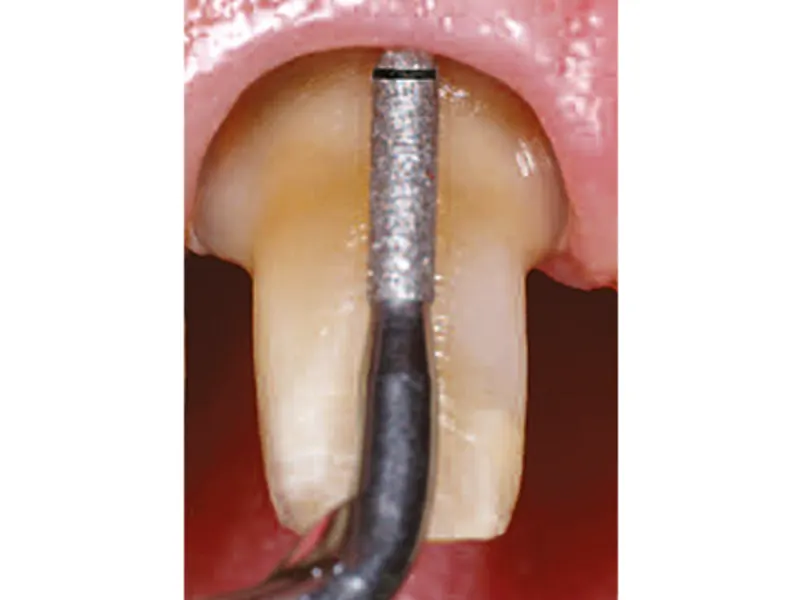 Satelec insert PM2 A29753 img