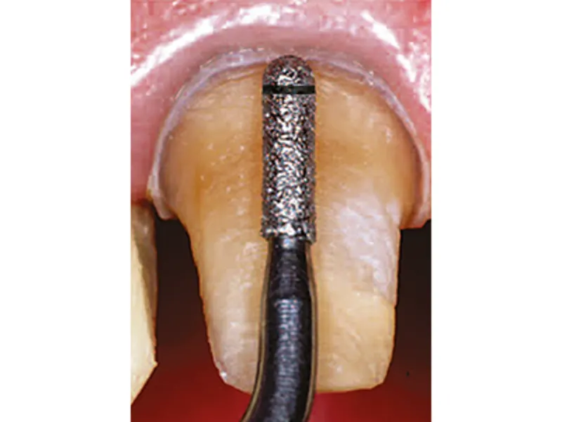 Satelec insert PM1 A34454 img