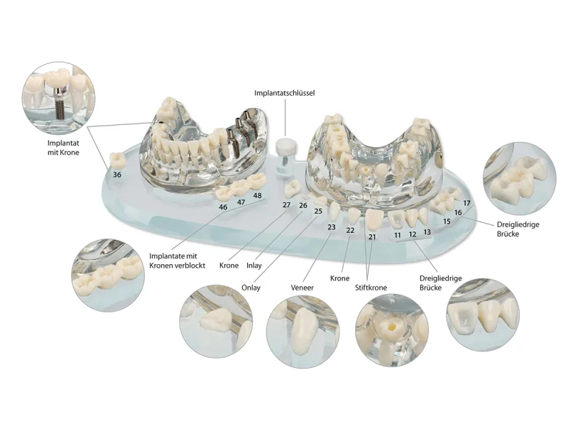 HW Studiemodel Implant -CB+koffer A39016 img