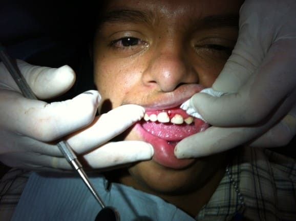 Our 18 year old Down Syndrome boy. Excellent patient
