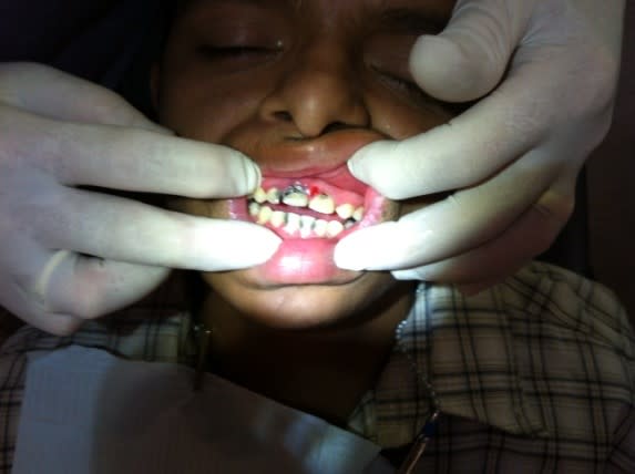 Our 18 year old Down Syndrome boy. Excellent patient