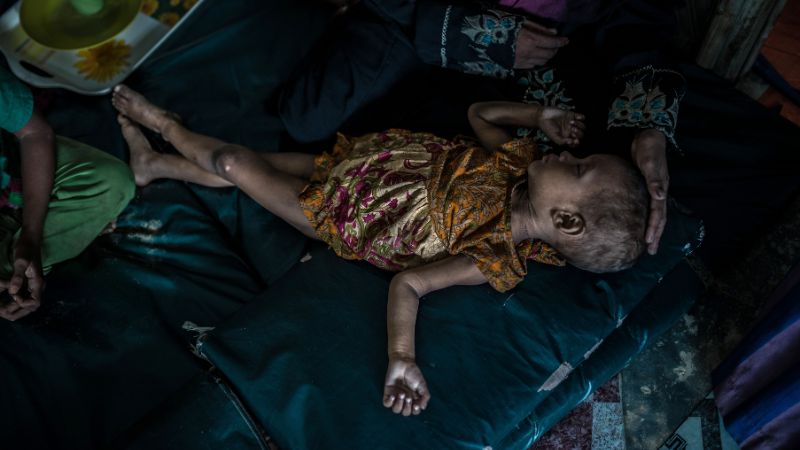 27% Surge in Severe Acute Malnutrition Among Rohingya Children