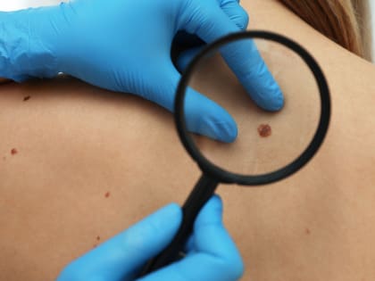 Доктор Мясников напомнил о риске появления и развития рака в атипичных родинках