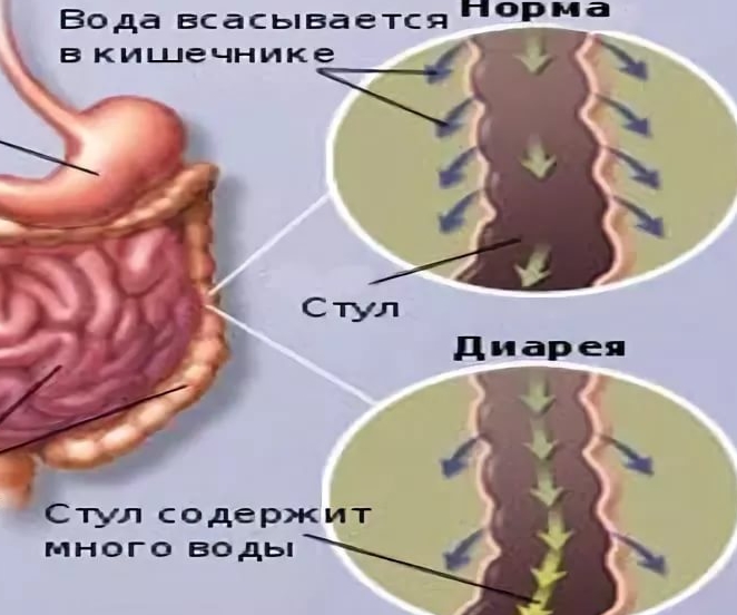 Бывает ли диарея. Профузный понос при каких заболеваниях.