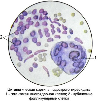 Цитологическая картина коллоидного узла что значит