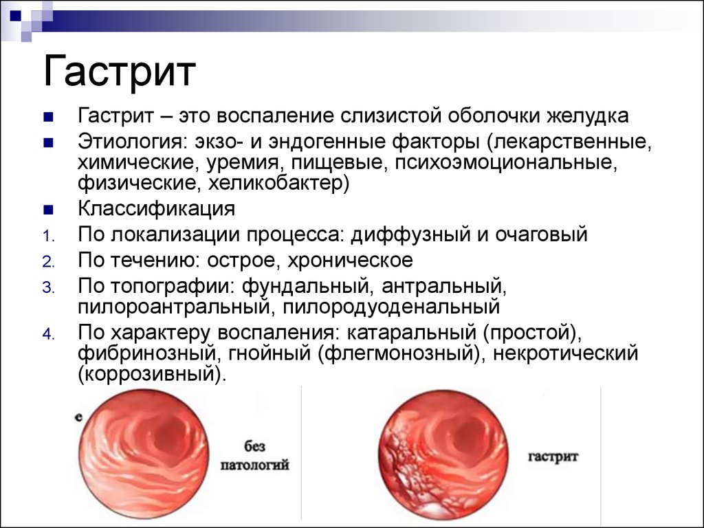 Почему после еды болит. Воспаление слизистой оболочки желудка. Острый и хронический гастрит. Острый и хронический гастрит причины. Ноющие боли в желудке после еды.