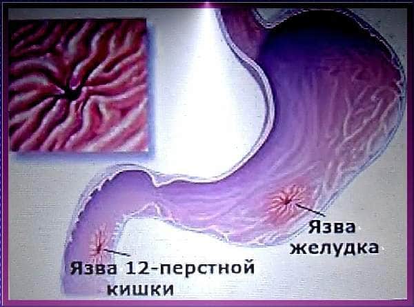 Код язвы 12 перстной кишки. Язва луковицы 12 перстной кишки. Язва желудка и 12 перстной кишки. Язва 12 перстной кишки кишки. Язва луковицы 12 перстной.