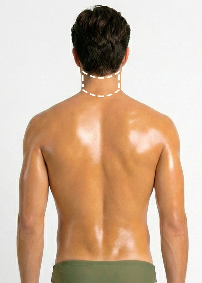 Depilación Láser Cervical delimitada