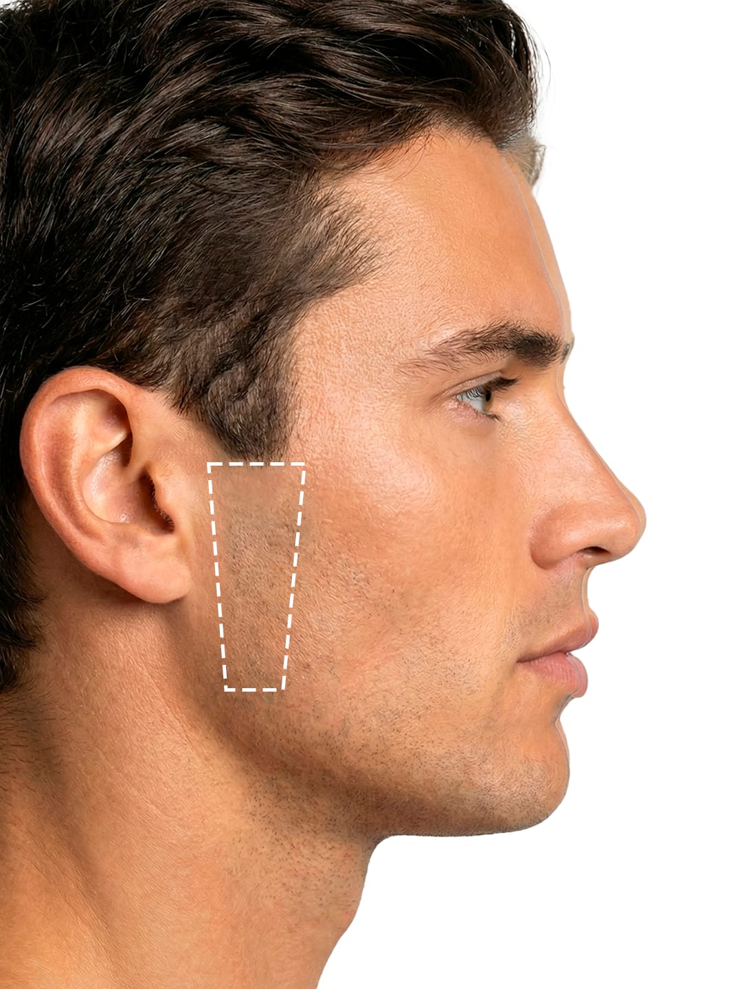 Depilación Láser Patillas sin delimitar