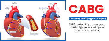 Coronary Artery Bypass Grafting (CABG)