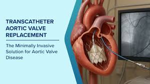 TAVR / TAVI — Transcatheter Aortic Valve Replacement