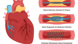 Coronary Angioplasty & Stenting