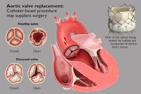 Heart Valve Replacement