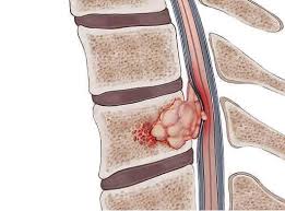 Spine Tumour Surgery