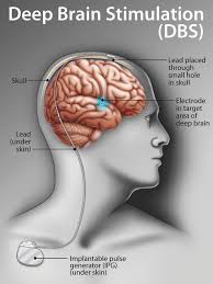 Deep Brain Stimulation (DBS)