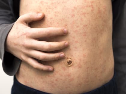 Депздрав Москвы подтвердил информацию о росте заболеваемости кори