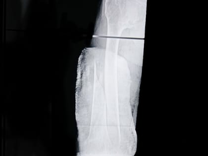 Закрытый перелом за две недели стал открытым