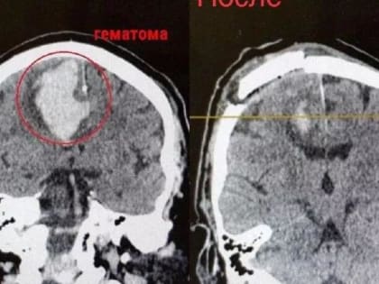 Врачи Подольска удалили пациенту с инсультом внутримозговую гематому объемом 55 мл