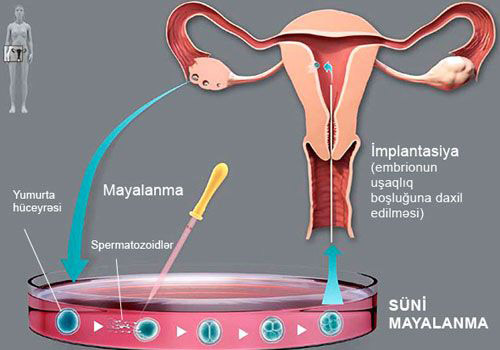 bu sekil suni mayalanma barededir