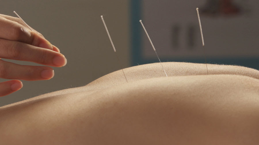 Acupuncture needles in the upper back