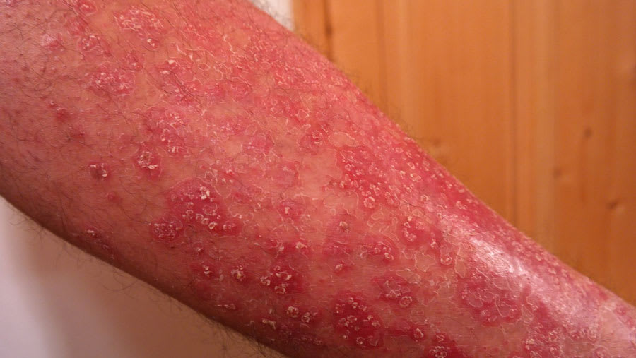 skin mircrobiome bacteria in psoriasis