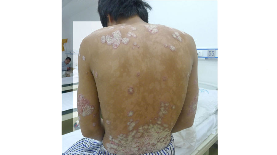 Psoriasis on the back in a clinic room
