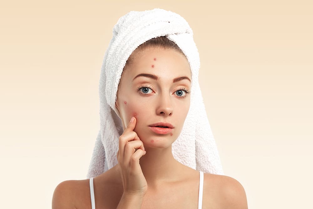 closeup-young-woman-with-towel-head-pimples-face
