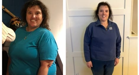 Woman before and after bariatric surgery