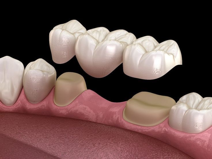 Bali Dental Assistance - Dental Bridge