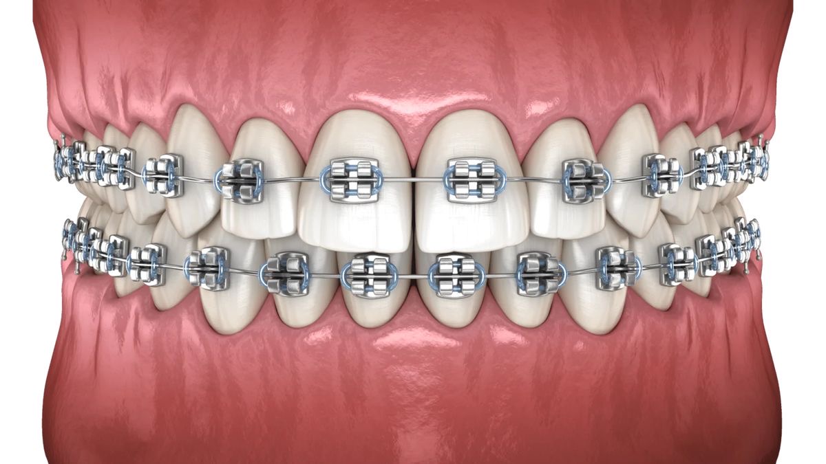 Bali Dental Assistance - Dental Braces