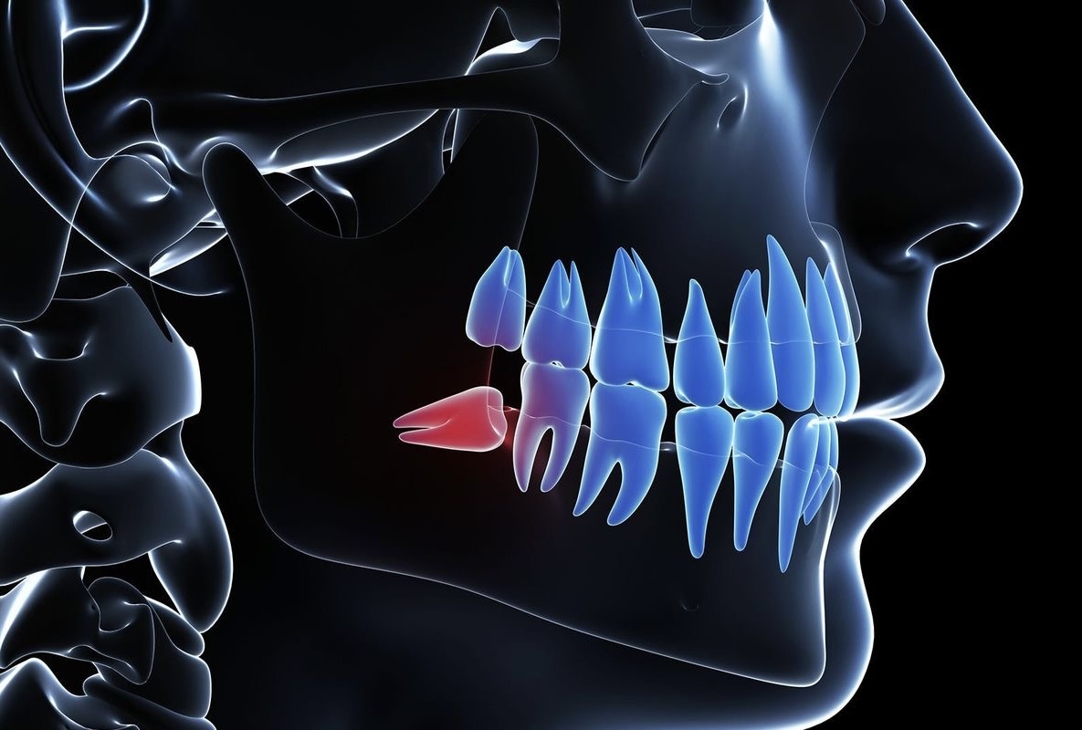 Bali Dental Assistance - Dental ⁠Odontectomy