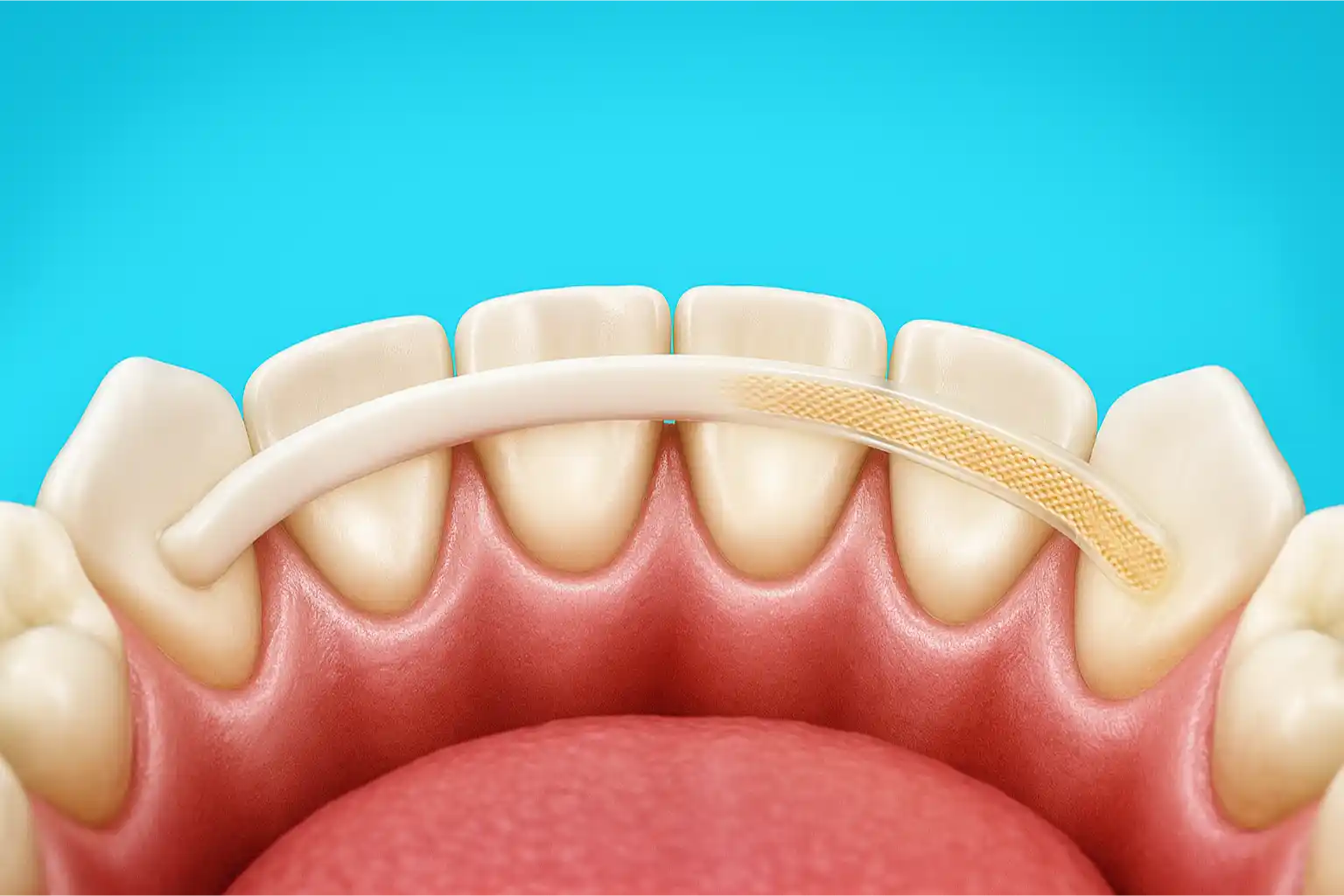 Bali Dental Assistance - Dental Splinting