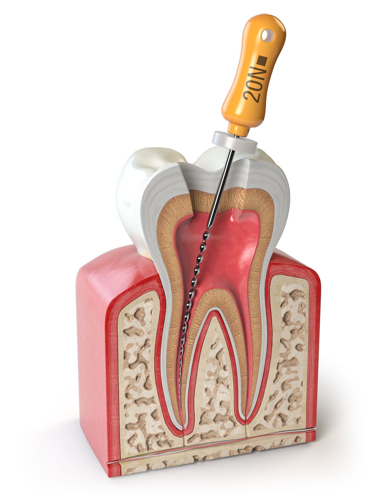 Bali Dental Assistance - Root Canal