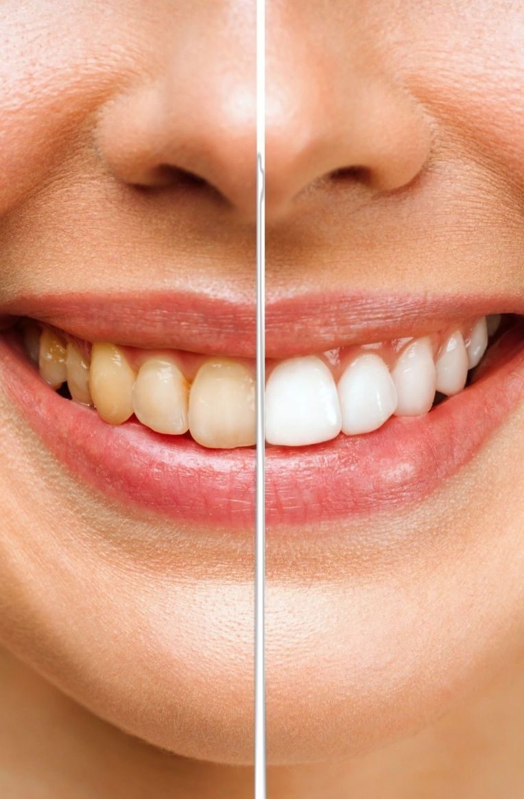 Bali Dental Assistance - Dental Whitening