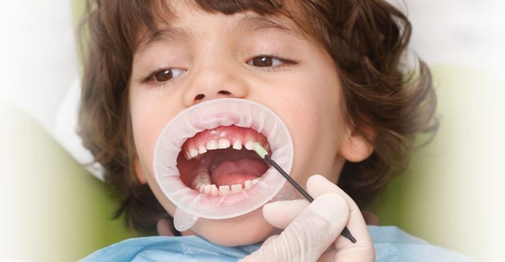 Bali Dental Assistance - Children Treatment