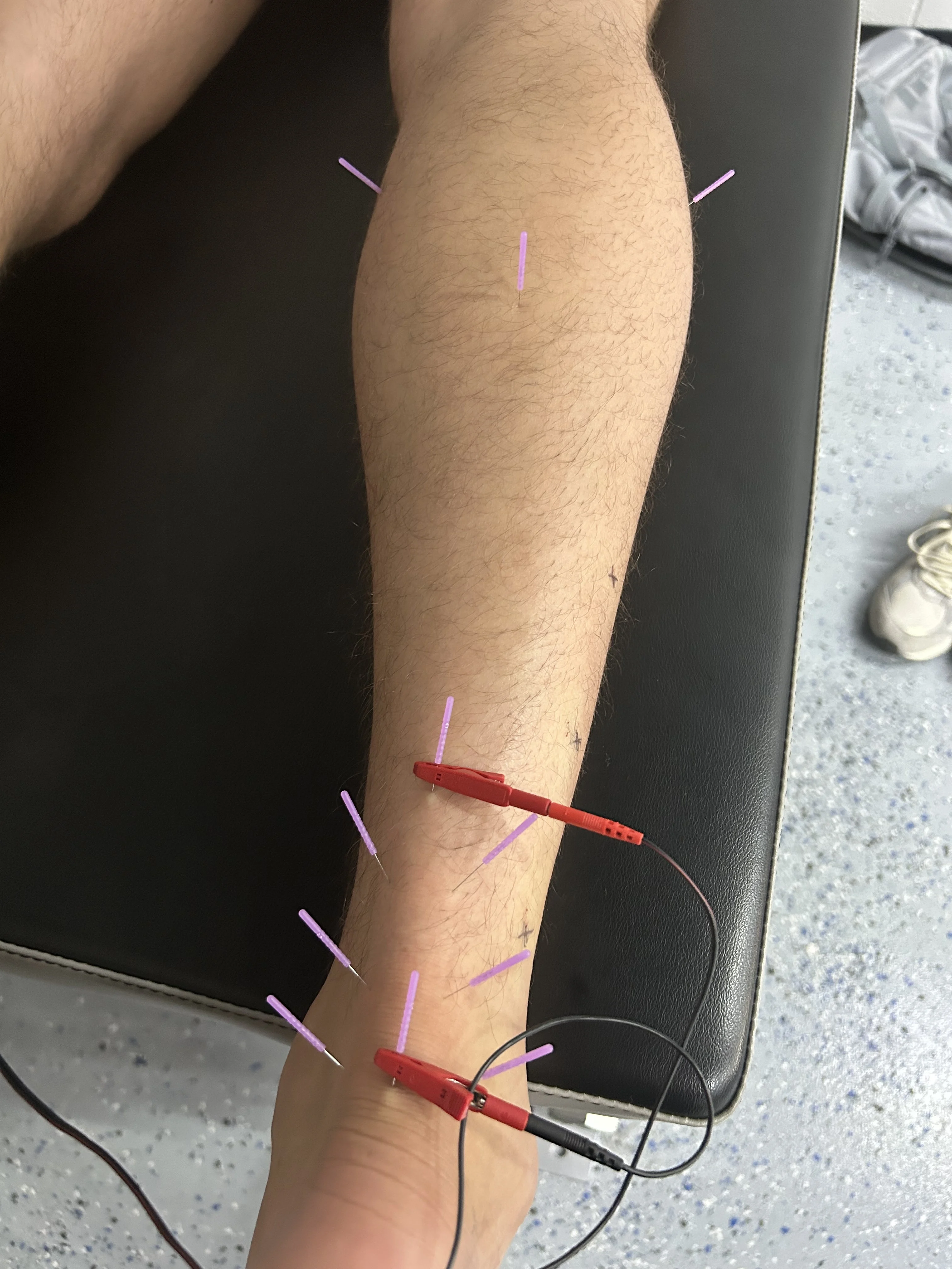 dry-needling